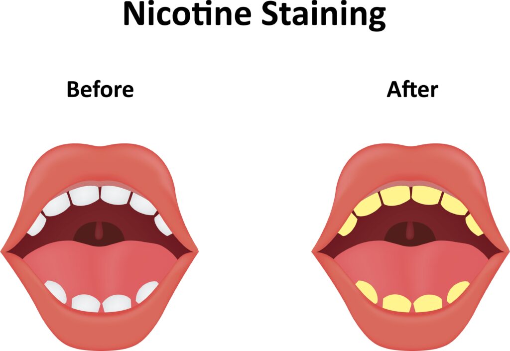 Vaping dental decay, vape dry mouth, vaper